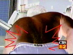 back pain