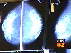 breast e-ray